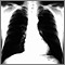 Cáncer bronquial - radiografía de tórax