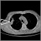 Masa pulmonar, pulmón derecho - Tomografía