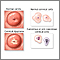 Neoplasia cervical