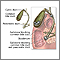 Coledocolitiasis