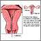 Biopsia endometrial