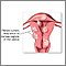 Tumores fibroides