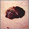 Cáncer de piel, melanoma - lesión oscura saliente