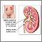 Nefrolitiasis