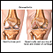 Osteoartritis