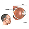 Retinitis por CMV