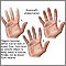 Fenómeno de Raynaud