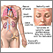 Lupus eritematoso sistémico
