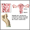 Prueba de vaginitis (montaje húmedo)