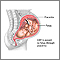 Citomegalovirus congénito