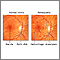 Retinopatía diabética