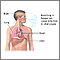 Coccidioidomicosis diseminada