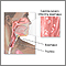 Esofagitis por Candida