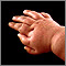 Polidactilia en la mano de un niño