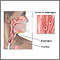 Esofagitis herpética