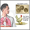 Histoplasmosis aguda