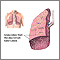 Tuberculosis miliar