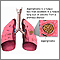 Aspergiloma