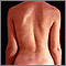 Escoliosis
