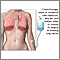 Tratamiento con quimioterapia - cáncer pulmonar