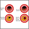 Proceso de evolución de la aterosclerosis