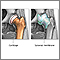 Osteoartritis contra artritis reumatoide