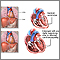 Cardiomiopatía alcohólica