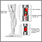 Embolia arterial
