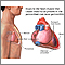 Pericarditis post-IM