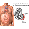 Cardiomiopatía periparto