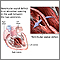 Defecto del tabique ventricular