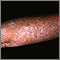 Queratosis actínica en el brazo
