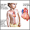 Coartación de la aorta