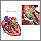 Endocarditis de cultivo negativo