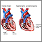 Cardiomiopatía hipertrófica