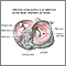 Endocarditis infecciosa