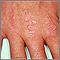 Dermatomiositis - pápulas de Gottron en las manos