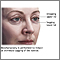 Blefaroplastia - serie