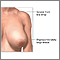 Reducción de mamas (mamoplastia) - serie - Indicaciones