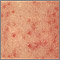 Primer plano de la queratosis pilaris