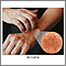 Dermatitis atópica