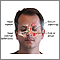 Sinusitis crónica