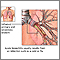 Causas de la bronquitis aguda