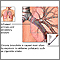 Causas de la bronquitis crónica