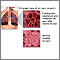 Enfermedad pulmonar obstructiva crónica (EPOC)