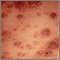 Leucemia monocítica aguda en la piel
