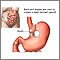 Gastroplastia vertical con banda