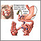 Derivación biliopancreática con cruce duodenal