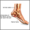 Fascitis plantar