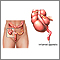 Apendicitis